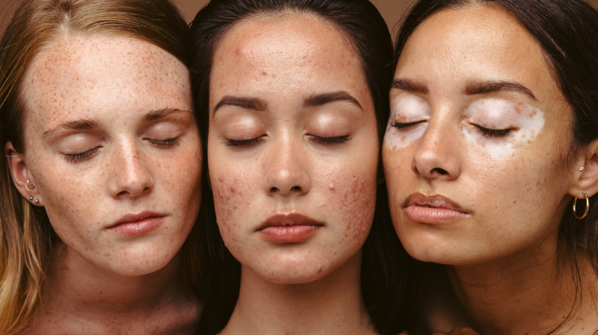 Drei Frauen mit unterschiedlichem Hautbild