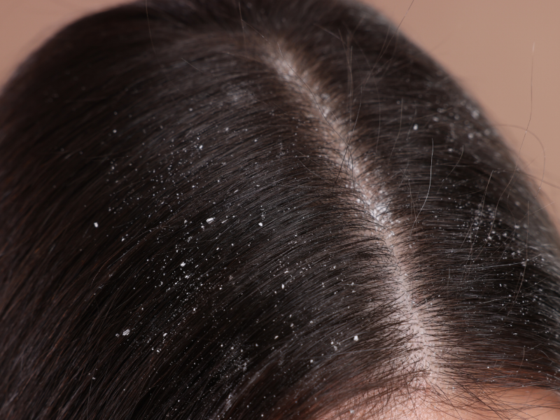 Nahaufnahme von Steitel mit Schuppen &uuml;bers&auml;ht.