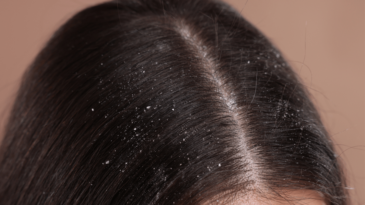 Nahaufnahme von Steitel mit Schuppen übersäht.