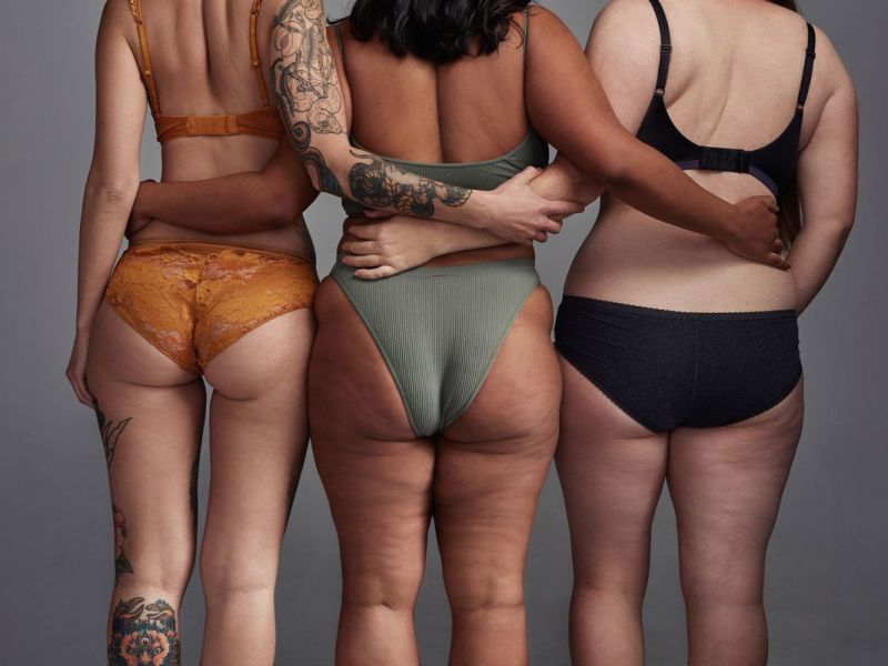 Orangenhaut: Deshalb haben manche Frauen Cellulite