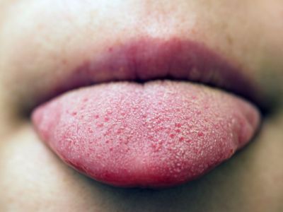 Pickel auf der Zunge: Bild einer gesunden Zunge mit Papillen