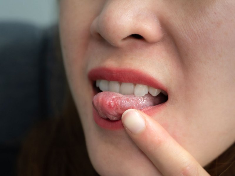 Pickel auf der Zunge: Ursachen für Aphten und was hilft