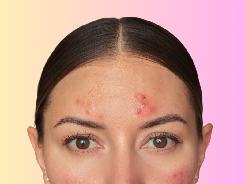 Frau vor einem bunten Hintergrund, die rote Pusteln im Gesicht hat