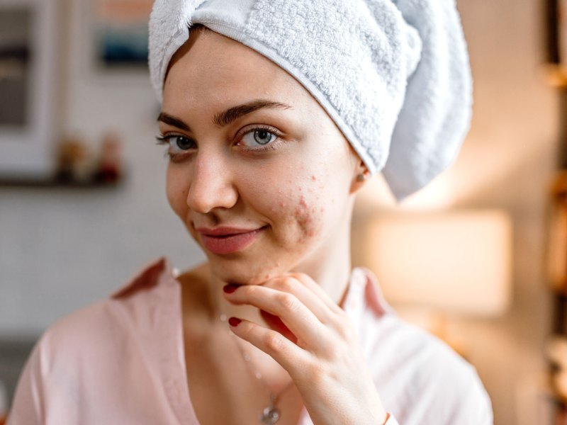 Frau mit einem Handtuch auf dem Kopf und kleinen Pickeln an der Wange