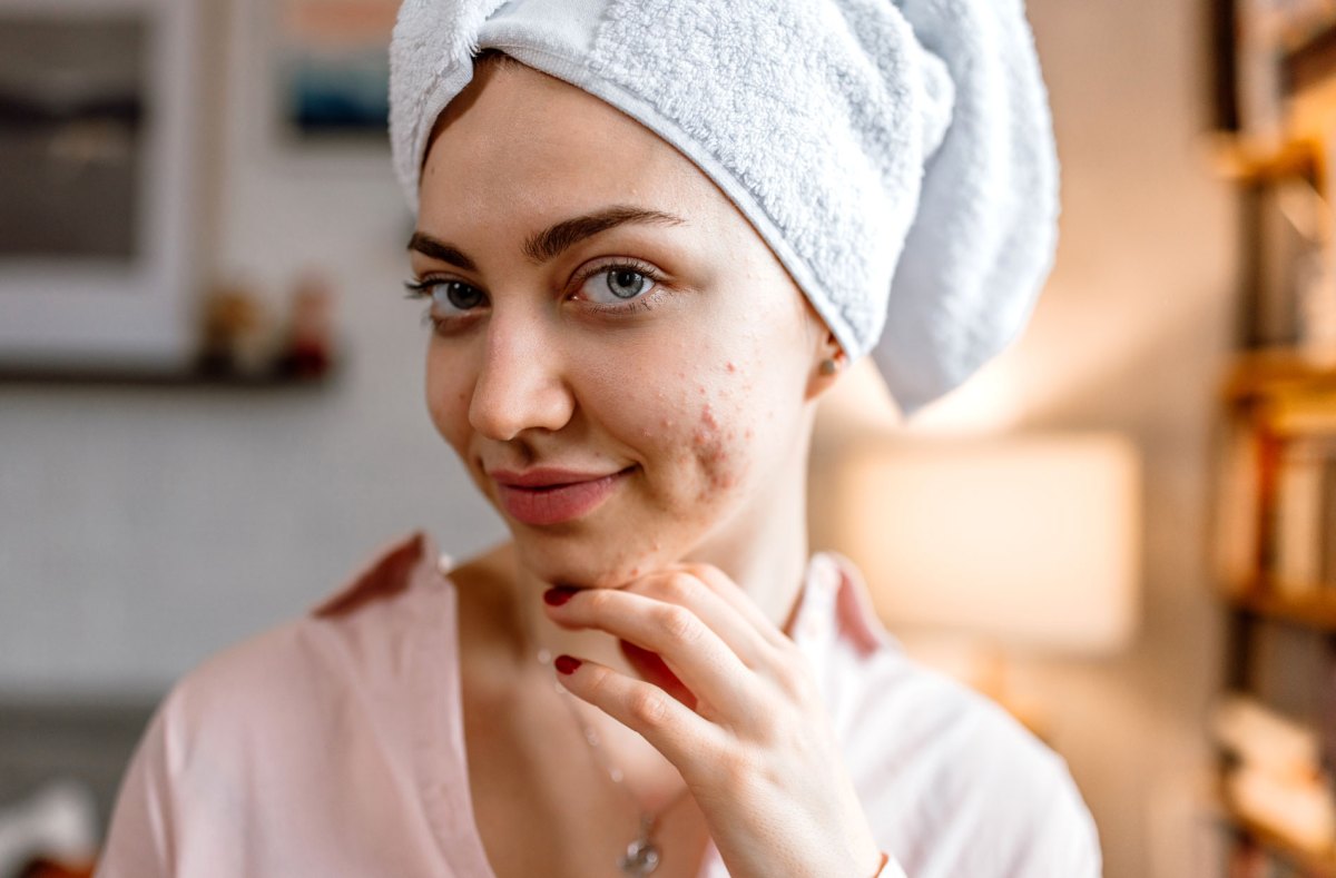 Frau mit einem Handtuch auf dem Kopf und kleinen Pickeln an der Wange