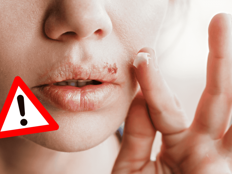 Frau hat Lippenherpes und gibt Creme darauf.