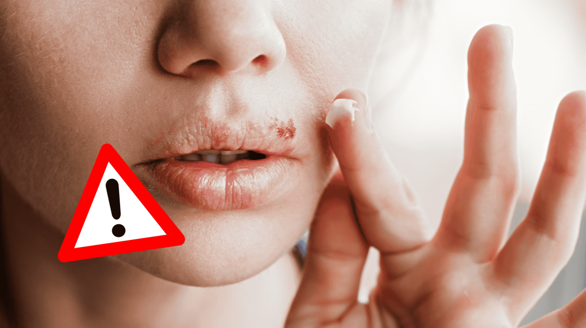 Frau hat Lippenherpes und gibt Creme darauf.