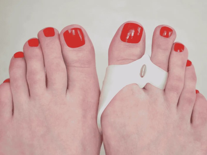 Zwei Füße von Frauen, am rechten trägt sie einen Schutz für Hallux Valgus.