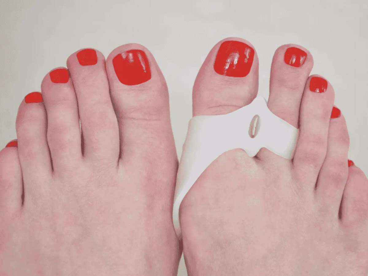 Zwei Füße von Frauen, am rechten trägt sie einen Schutz für Hallux Valgus.