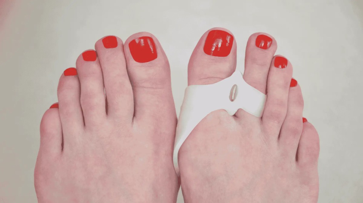 Zwei Füße von Frauen, am rechten trägt sie einen Schutz für Hallux Valgus.
